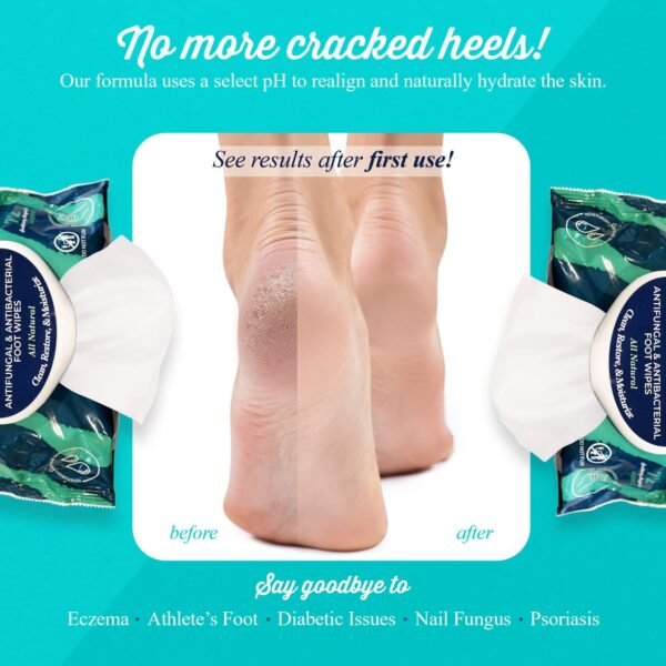 pHeet® Foot Wipes All-Natural Antifungal & Antibacterial Formula, Cleanses, Moisturizes, Prevents & Kills Athletes Foot, Toenail & Foot Fungus, Odor & Improves Dry, Cracked, Flaky & Diabetic Skin 72ct - Image 4